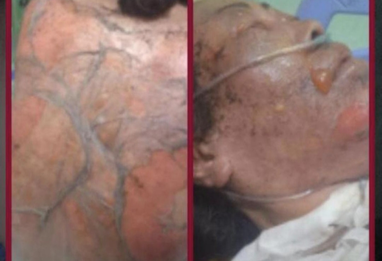korban luka bakar kasus pria bakar mantan istri dan mertua di Jepara
